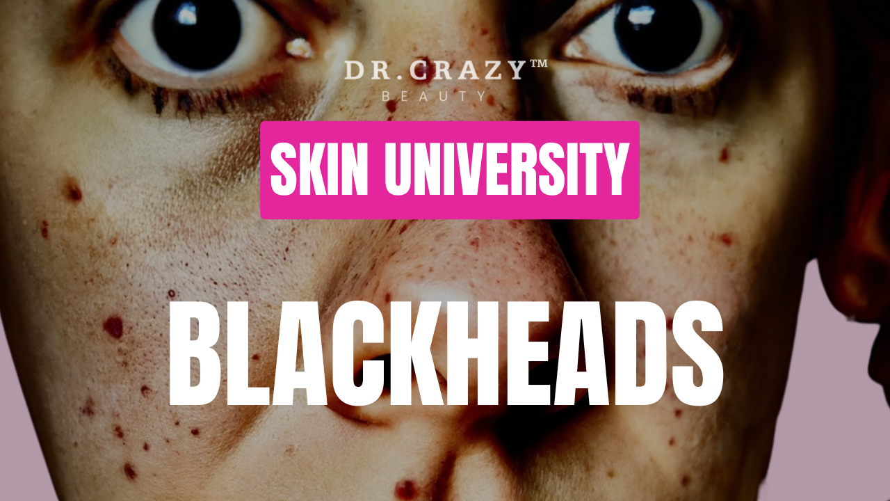 Blackheads: How to Effectively Remove and Prevent Them for Clearer Skin