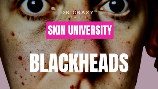 Blackheads: How to Effectively Remove and Prevent Them for Clearer Skin