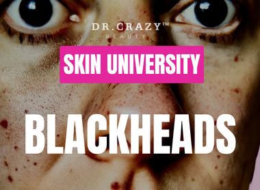 Blackheads: How to Effectively Remove and Prevent Them for Clearer Skin
