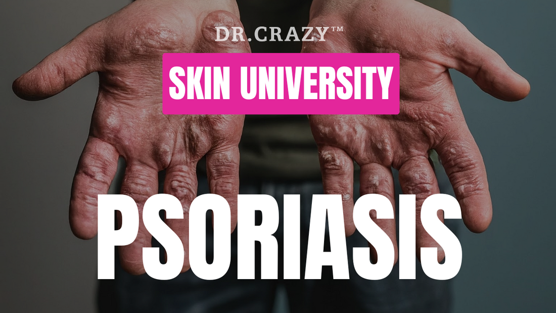 Psoriasis: How to Manage and Treat This Chronic Skin Condition