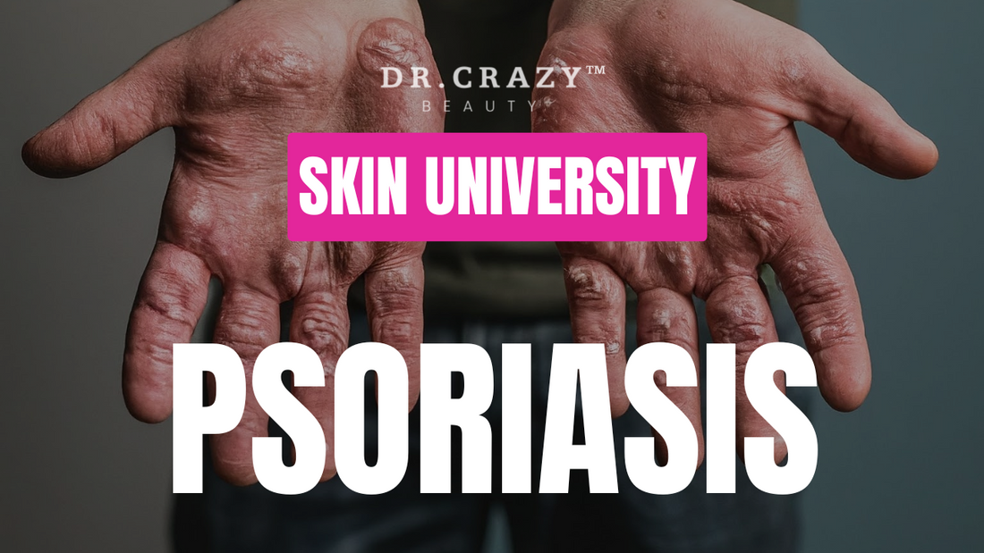 Psoriasis: How to Manage and Treat This Chronic Skin Condition