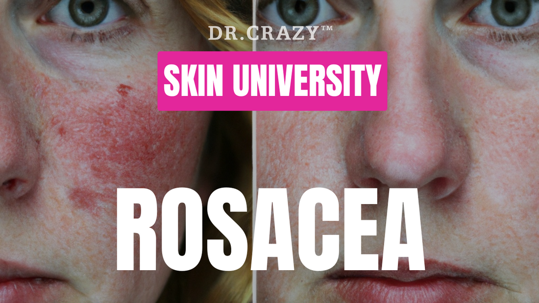 Rosacea: How to Manage Redness and Soothe Sensitive Skin