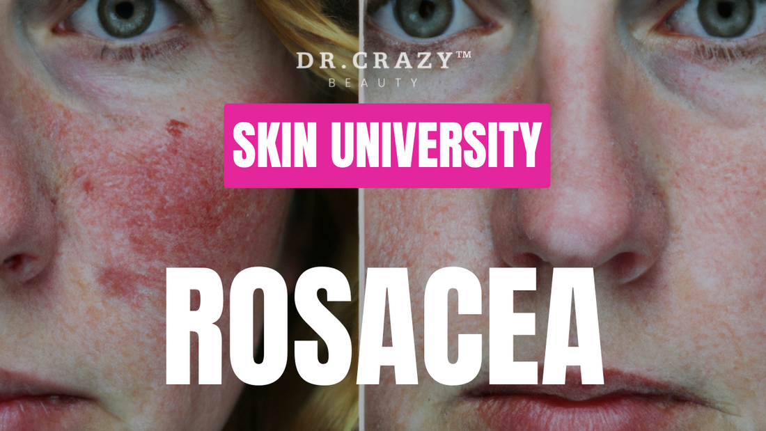 Rosacea: How to Manage Redness and Soothe Sensitive Skin