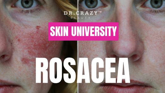 Rosacea: How to Manage Redness and Soothe Sensitive Skin