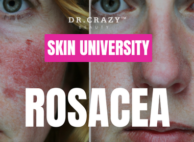 Rosacea: How to Manage Redness and Soothe Sensitive Skin