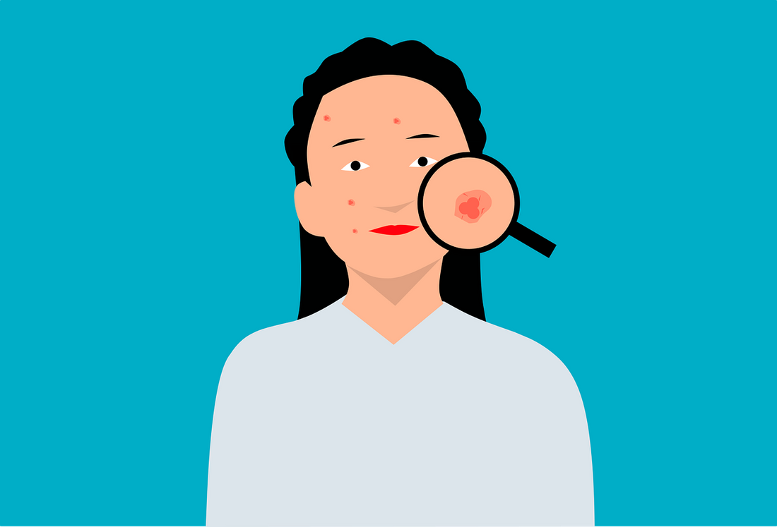 Does Salicylic Acid Help with Acne Scars?