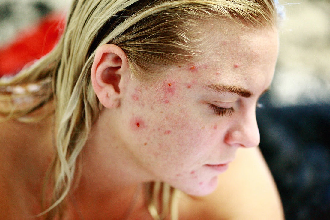 Does Vitamin C Serum Cause Acne?