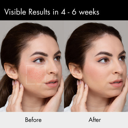 Beorht Moisturiser For Acne Prone Skin