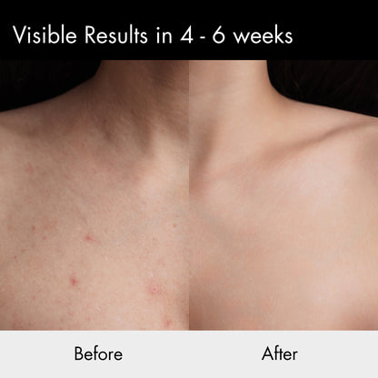 Beorht Exfoliating Body Spray - Acne Spray for Body
