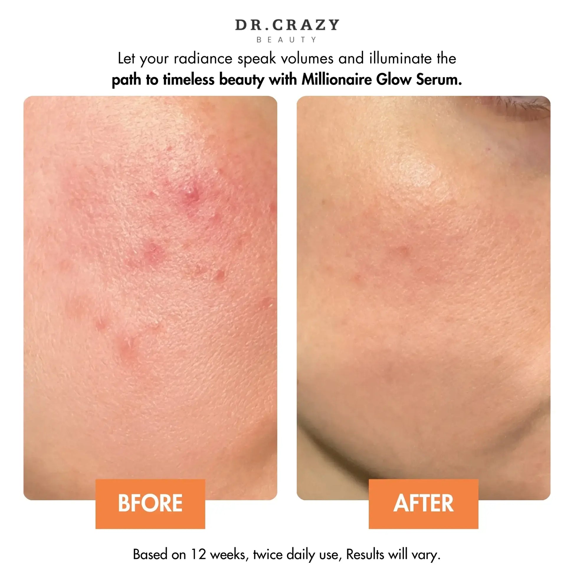 est Glow Serum for Dark Spots and Hyperpigmentation – Millionaire Glow Delivers Korean Glass Skin Results with Powerful Antioxidants