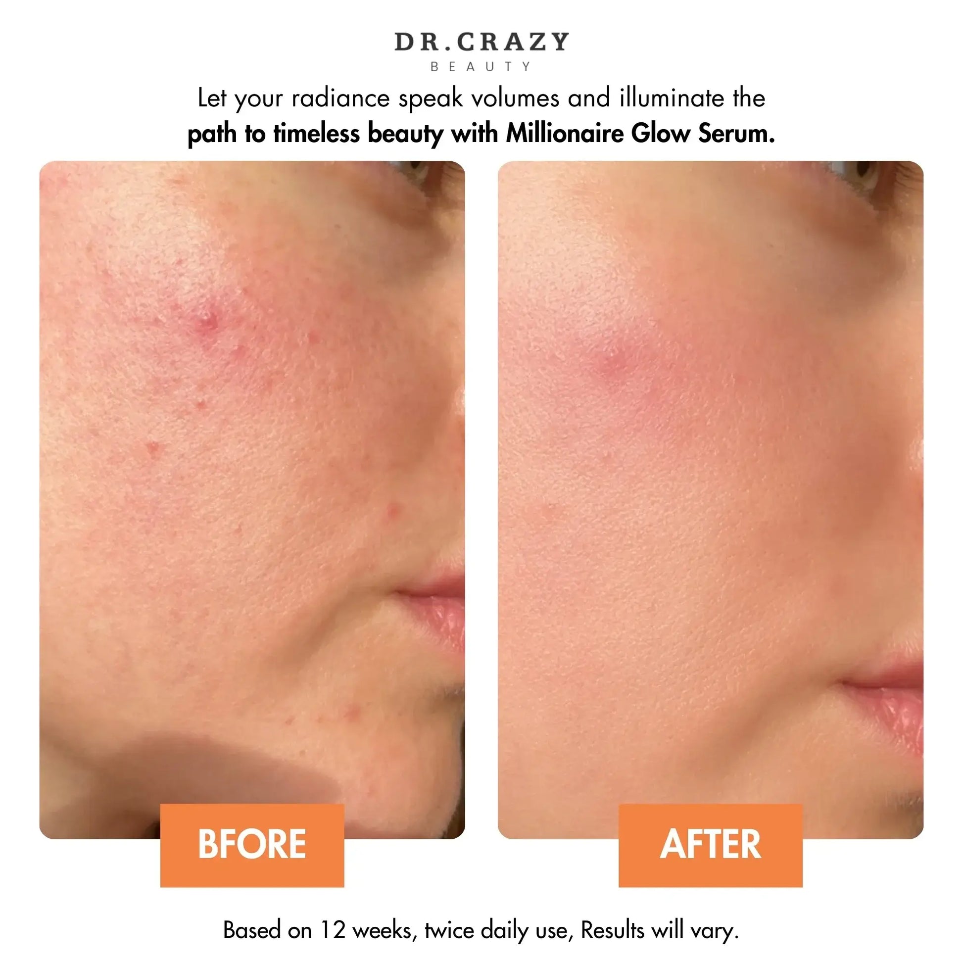 Close-Up of Millionaire Glow Serum Bottle – Vitamin C + Niacinamide Formula for Bright, Smooth, Hydrated Skin | Best Serum for Face Glow, Before and After Millionaire Glow Serum – Fade Acne Marks, Dark Spots & Discoloration | Achieve a Flawless, Dewy Glas