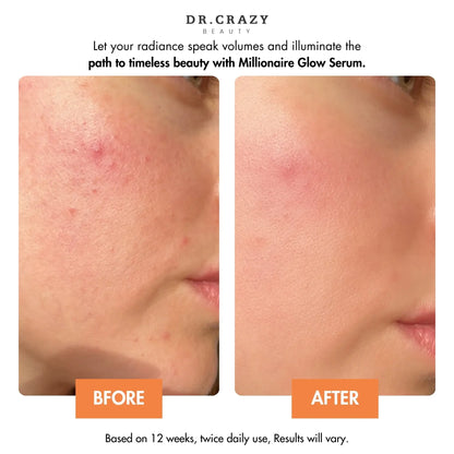 Close-Up of Millionaire Glow Serum Bottle – Vitamin C + Niacinamide Formula for Bright, Smooth, Hydrated Skin | Best Serum for Face Glow, Before and After Millionaire Glow Serum – Fade Acne Marks, Dark Spots & Discoloration | Achieve a Flawless, Dewy Glas