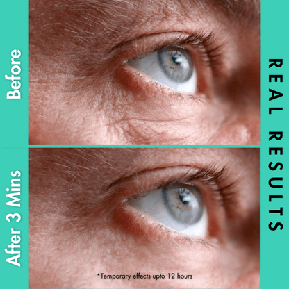 how to get rid of eye bags