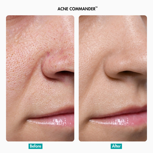 Before After Beorht Purifying Gel Cleanser by Acne Command