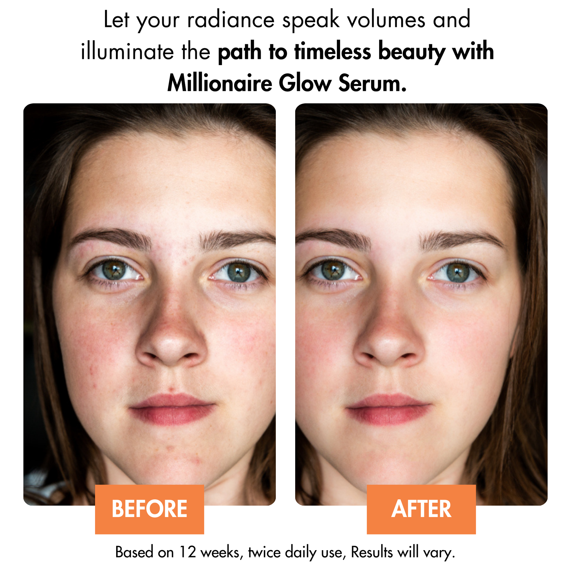 Before and after results using Dr. Crazy Millionaire Glow Serum. Skin appears brighter, more even-toned, and deeply hydrated with reduced pigmentation and a radiant glow.