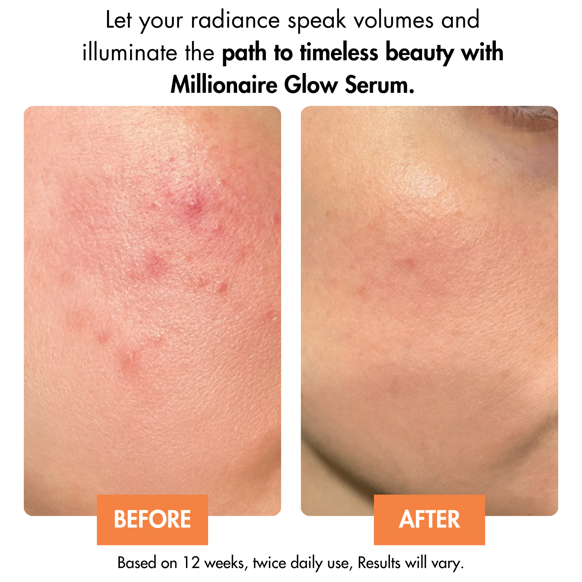 Before and after results using Dr. Crazy Millionaire Glow Serum. Skin appears brighter, more even-toned, and deeply hydrated with reduced pigmentation and a radiant glow.