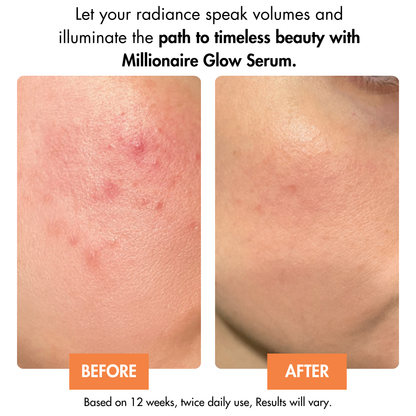 Before and after results using Dr. Crazy Millionaire Glow Serum. Skin appears brighter, more even-toned, and deeply hydrated with reduced pigmentation and a radiant glow.