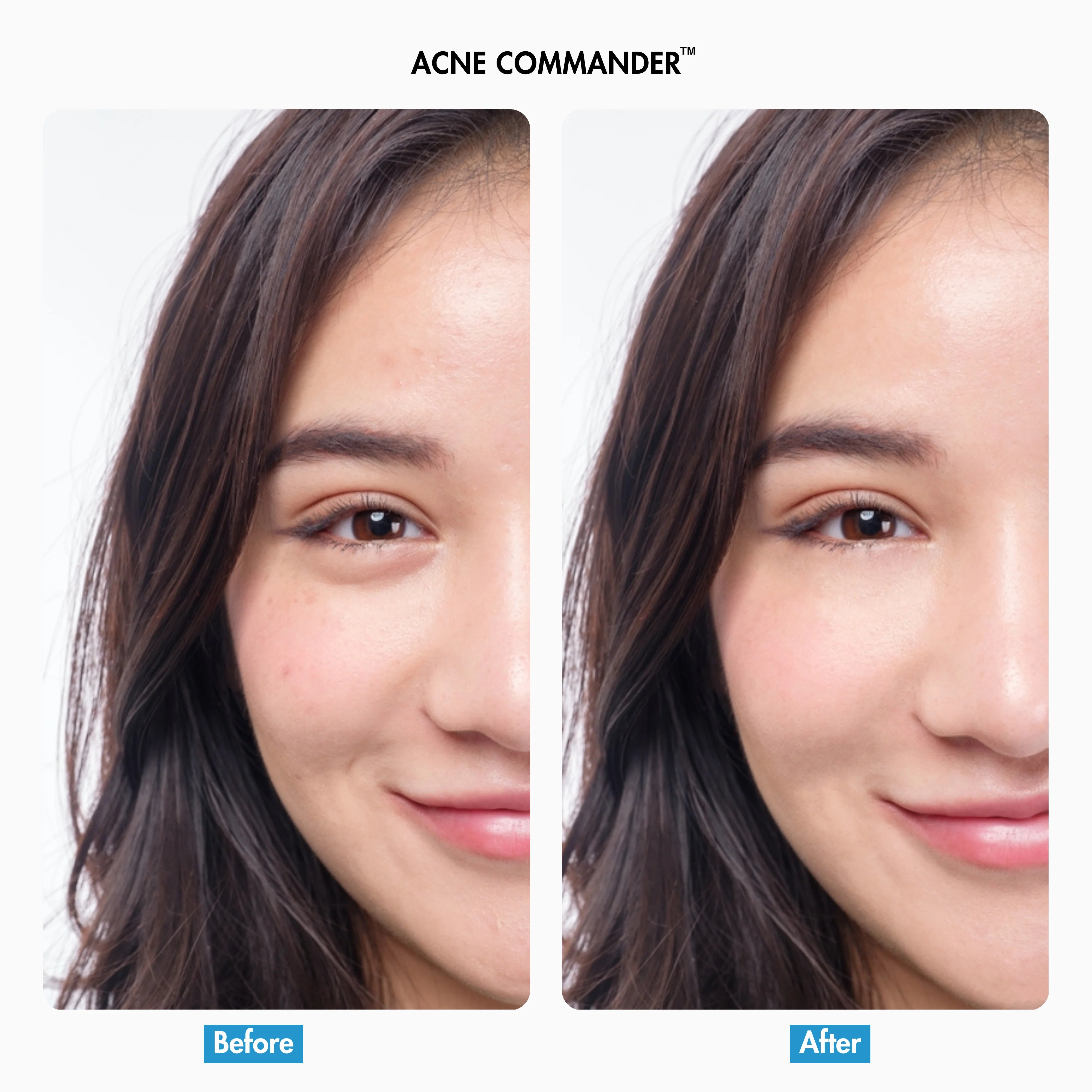 Before After of Our Acne Commander Moisturiser