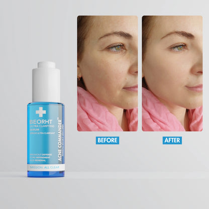 Before_After_of_Ultra_Clarifying_Serum_by_Acne_Commander